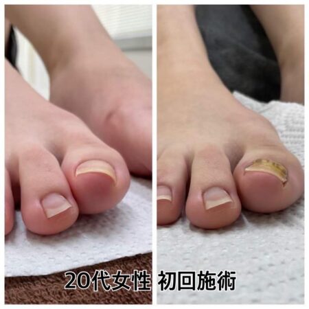20代女性初回施術