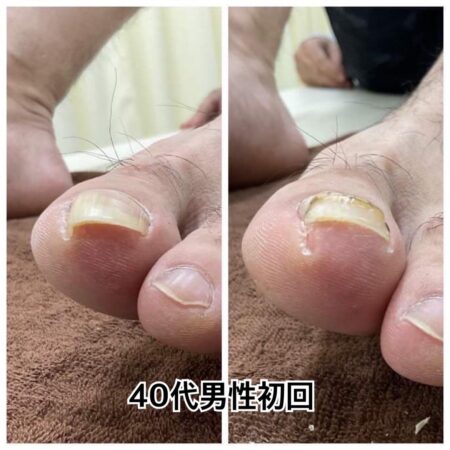 40代男性初回施術