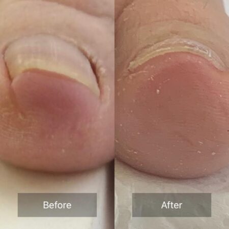 巻き爪ビフォーアフター