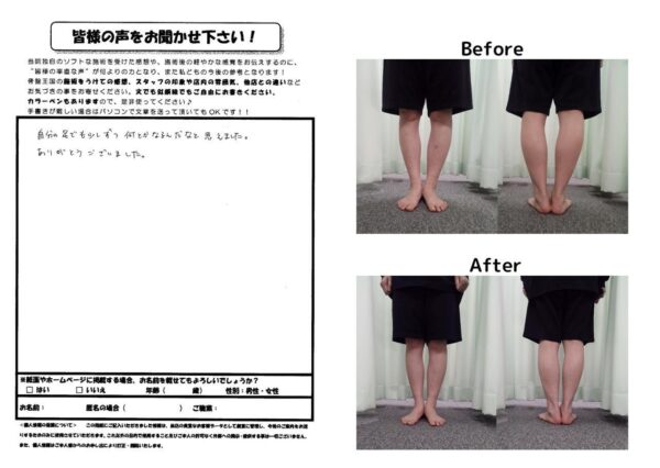 O脚ビフォーアフター