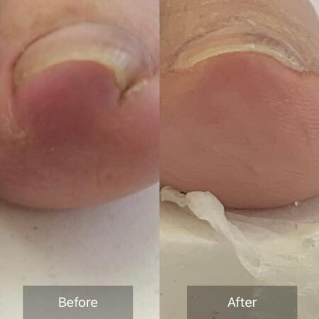 巻き爪ビフォーアフター