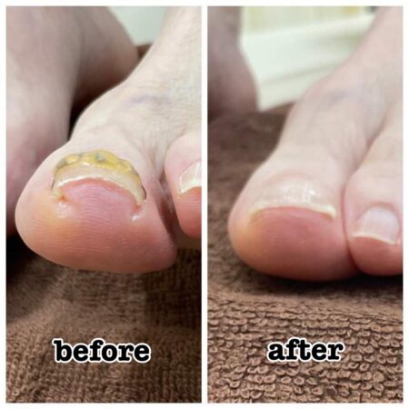 巻き爪ビフォーアフター