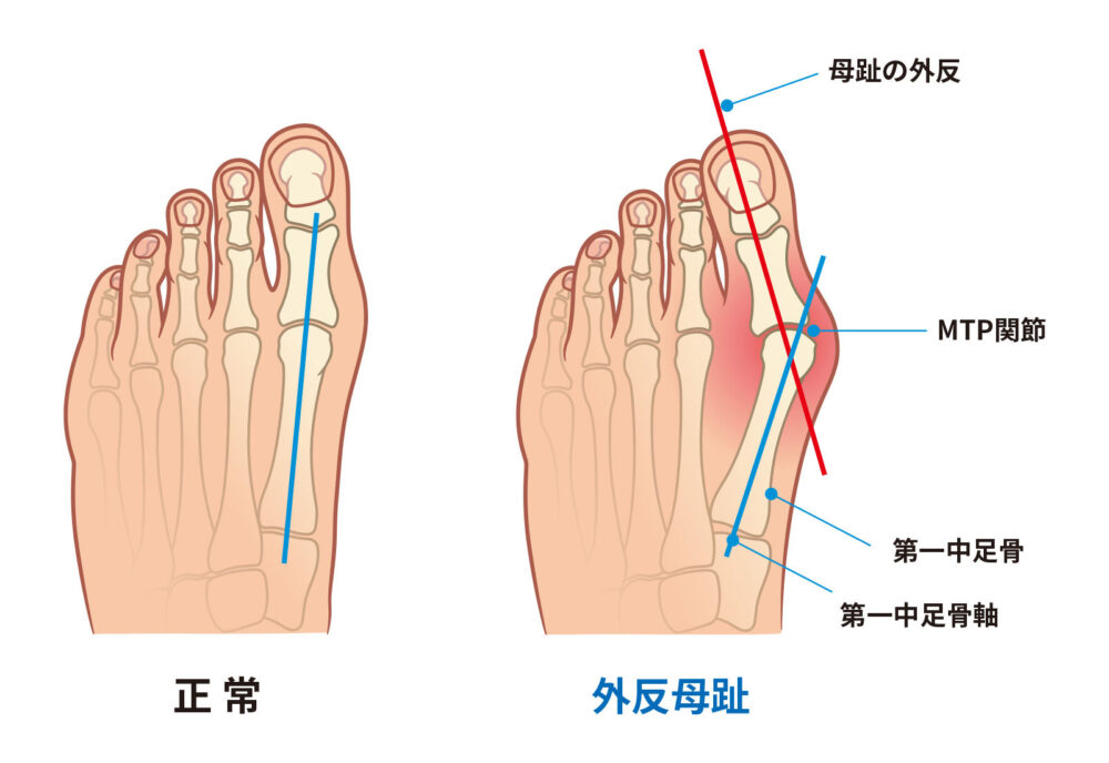 【八王子で外反母趾にお悩みの方へ】痛みの原因・治し方・整体の選び方を専門家が解説