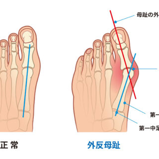【八王子で外反母趾にお悩みの方へ】痛みの原因・治し方・整体の選び方を専門家が解説
