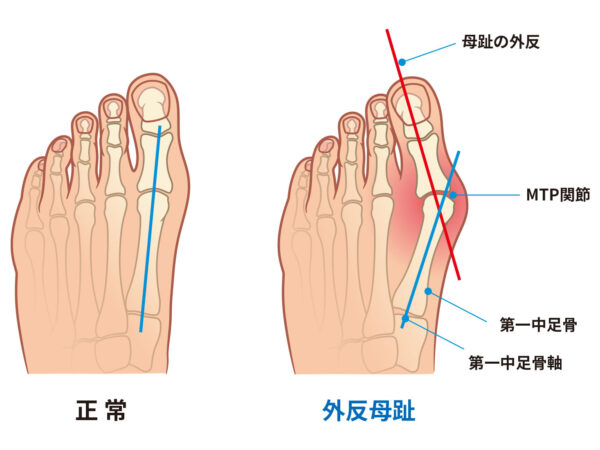 【八王子で外反母趾にお悩みの方へ】痛みの原因・治し方・整体の選び方を専門家が解説