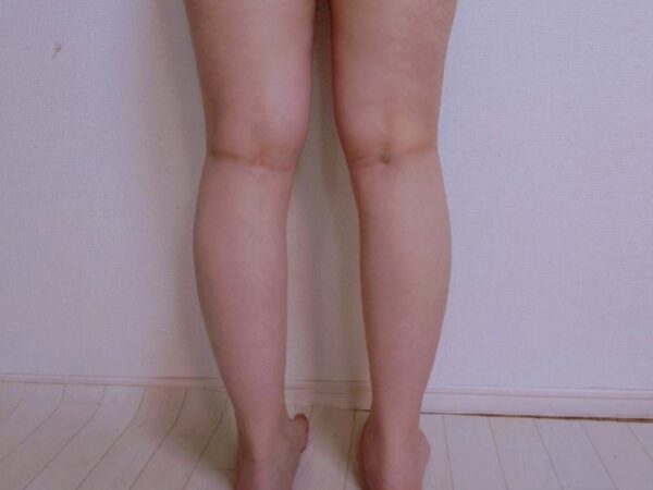 子供のO脚・X脚は成長の問題か？見極めと親の関わり方