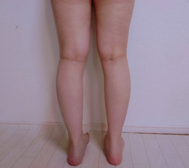 子供のO脚・X脚は成長の問題か？見極めと親の関わり方