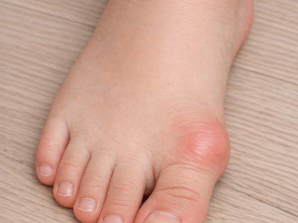 子供の外反母趾は成長のサインか 早期に気づく親の視点