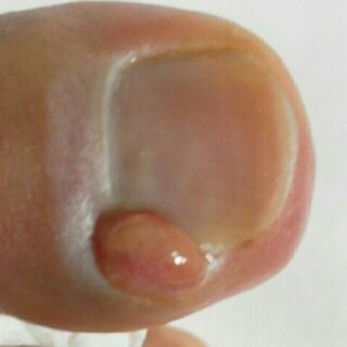 子供の陥入爪はなぜ起こる？原因と家庭でできる正しい対処法