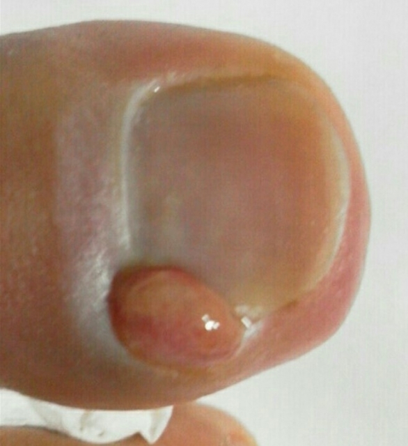 子供の陥入爪はなぜ起こる？原因と家庭でできる正しい対処法