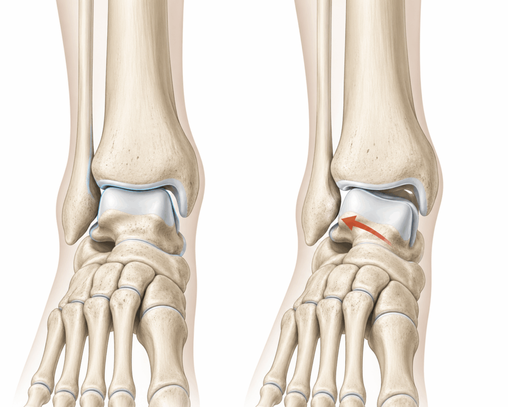 10年以上治らなかった足首の痛み。その正体は「外側荷重」と距骨のズレでした