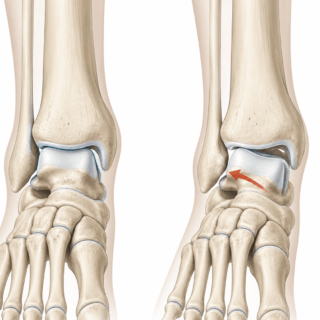 10年以上治らなかった足首の痛み。その正体は「外側荷重」と距骨のズレでした