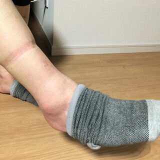 足のむくみは、歩けば改善するとは限りません